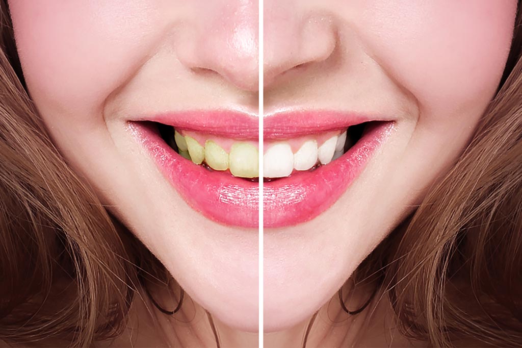 A woman's teeth before and after